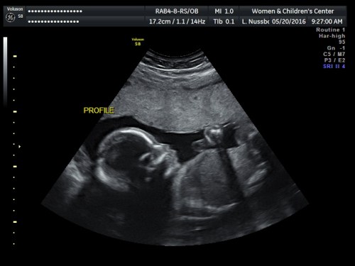 baby ultrasound